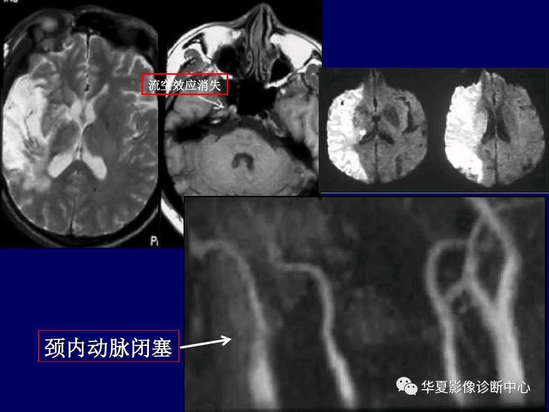 影像PPT - 【PPT】缺血性脑血管病的影像诊断-18