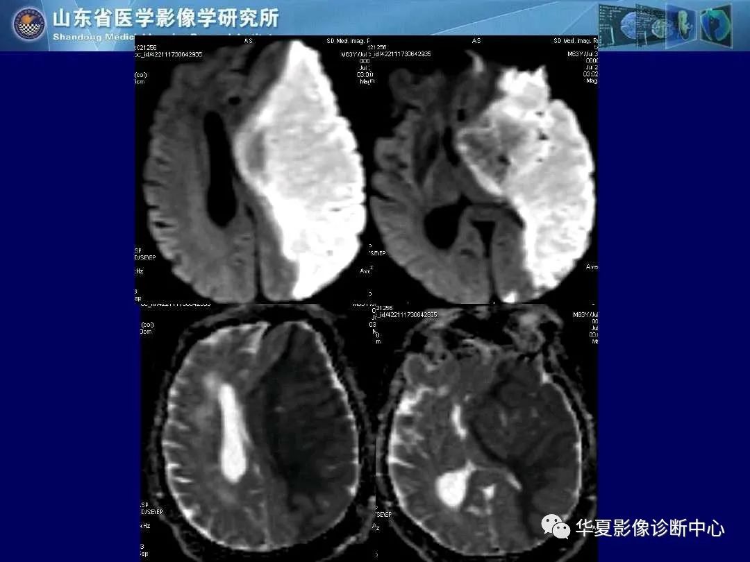 影像PPT - 【PPT】缺血性脑血管病的影像诊断-19
