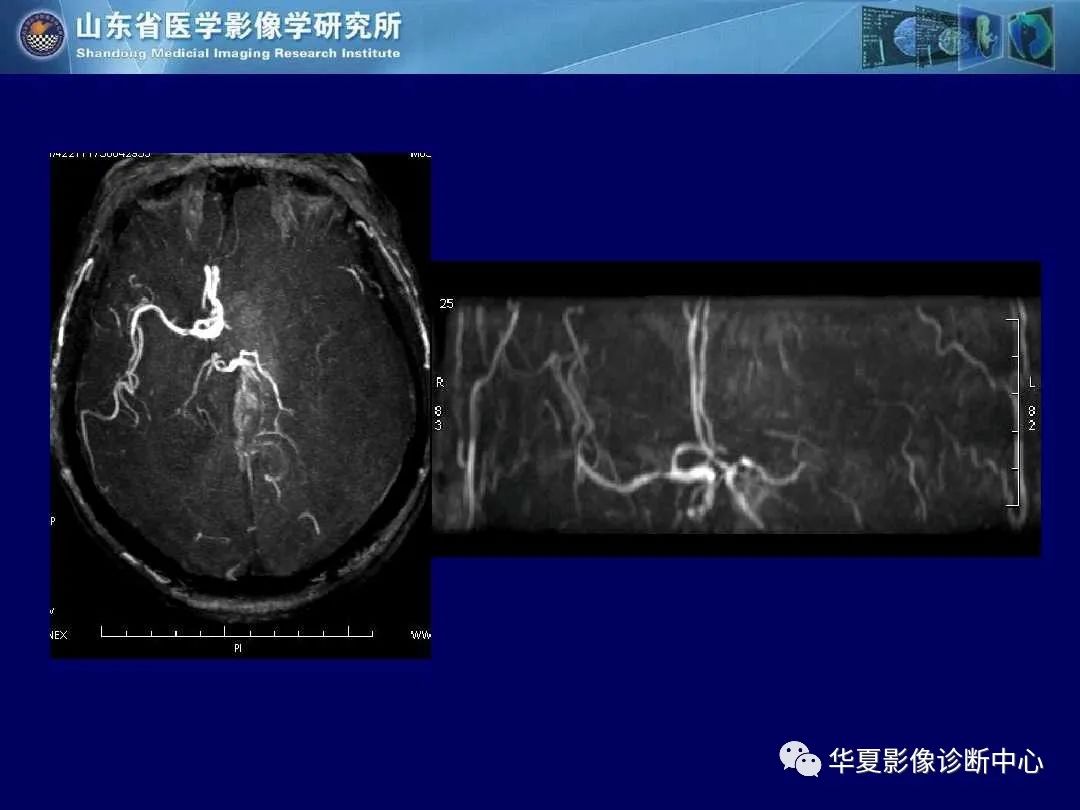 影像PPT - 【PPT】缺血性脑血管病的影像诊断-20