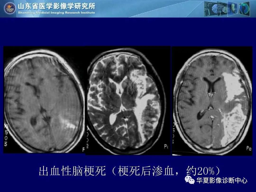 影像PPT - 【PPT】缺血性脑血管病的影像诊断-23