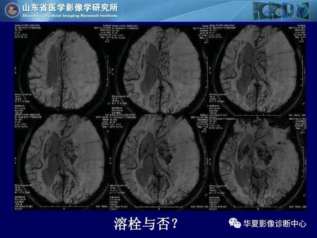 影像PPT - 【PPT】缺血性脑血管病的影像诊断-21