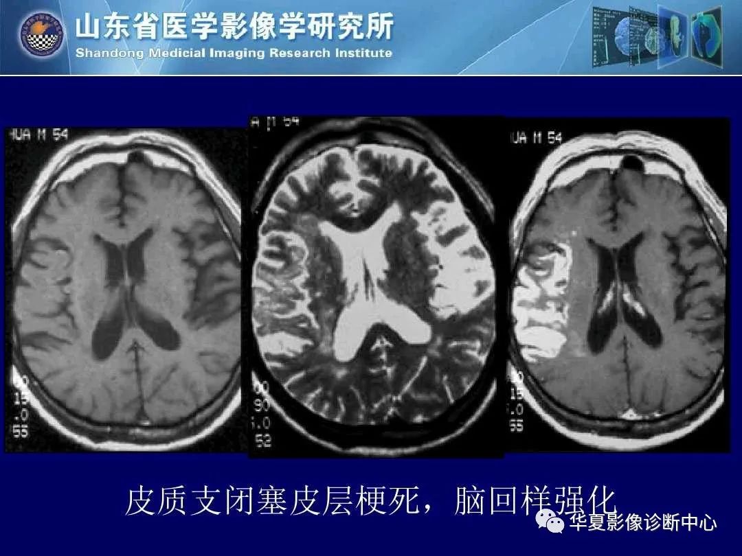 影像PPT - 【PPT】缺血性脑血管病的影像诊断-22