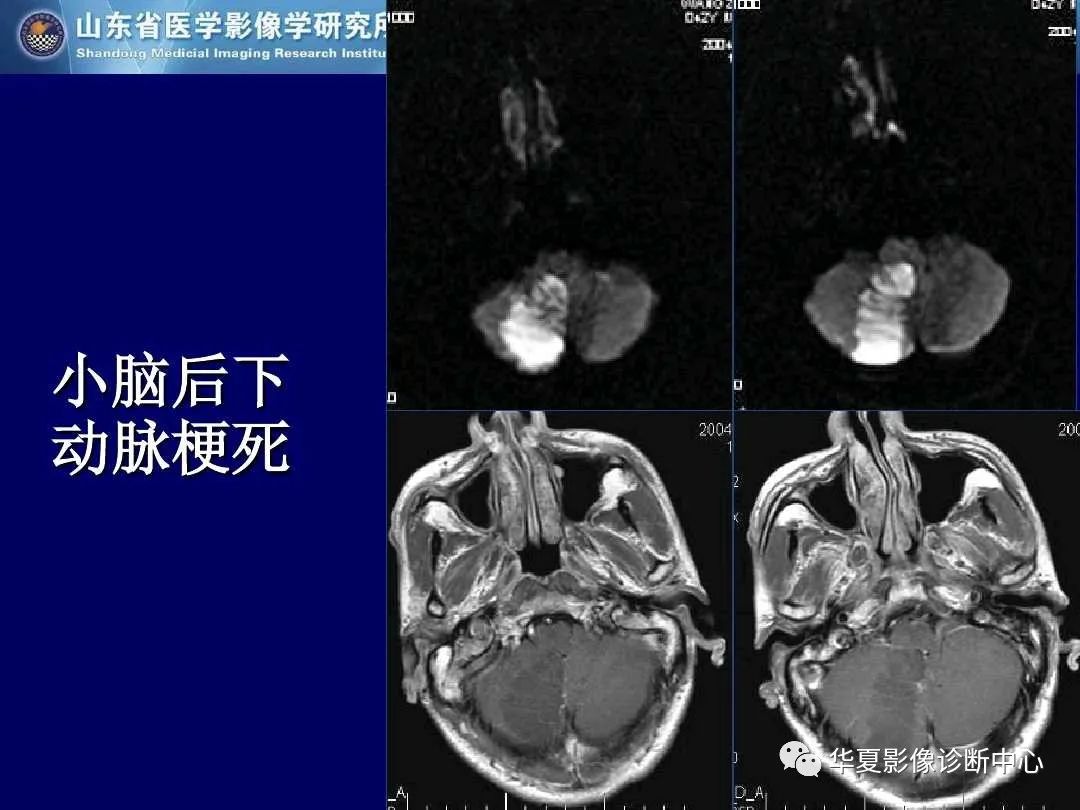 影像PPT - 【PPT】缺血性脑血管病的影像诊断-25