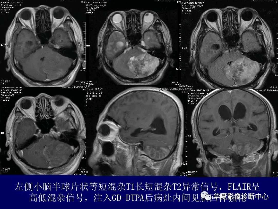 影像PPT - 【PPT】缺血性脑血管病的影像诊断-26