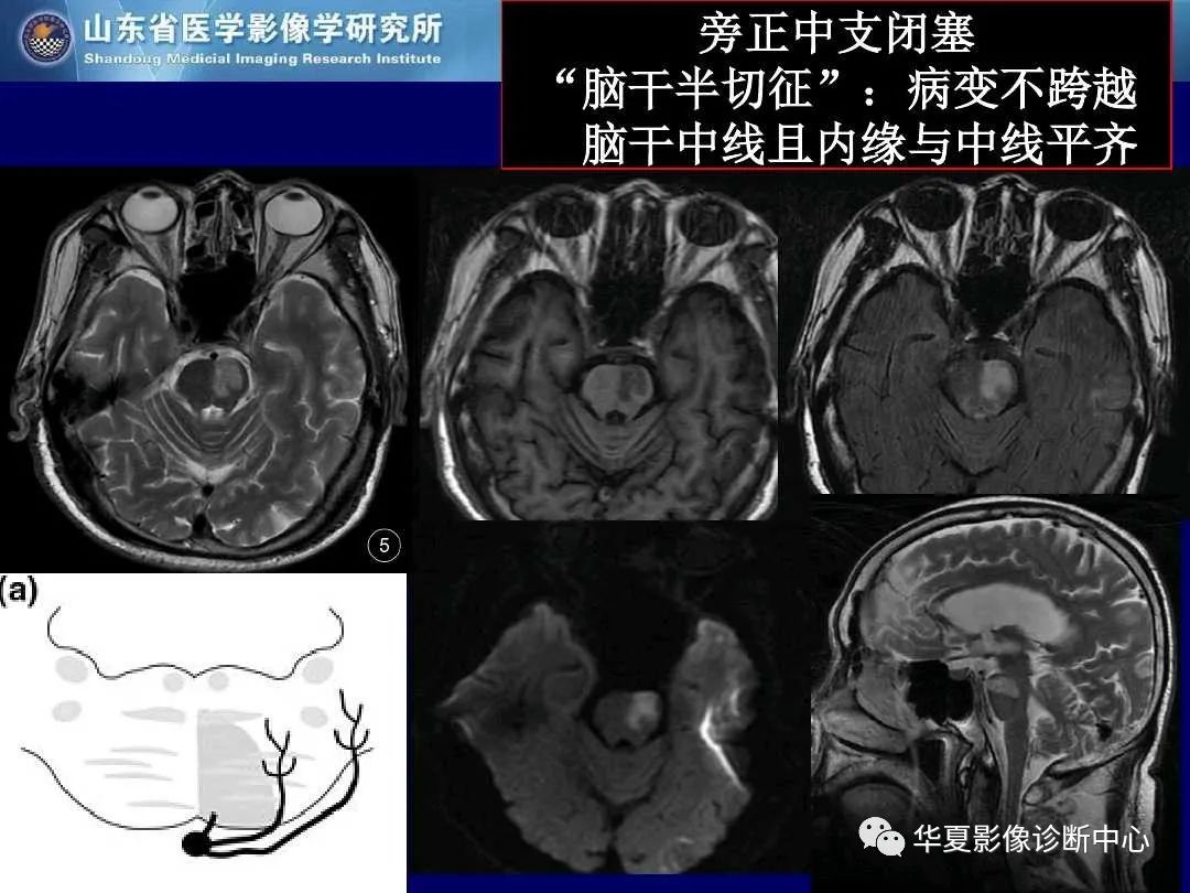影像PPT - 【PPT】缺血性脑血管病的影像诊断-30