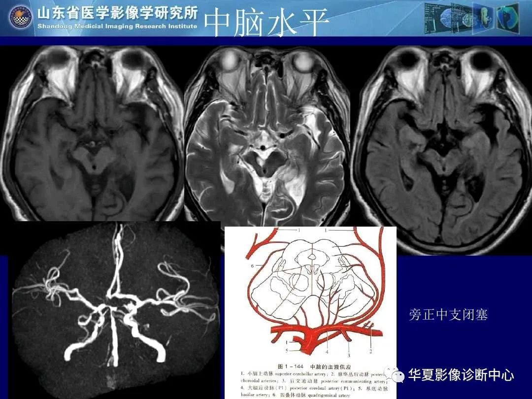 影像PPT - 【PPT】缺血性脑血管病的影像诊断-31