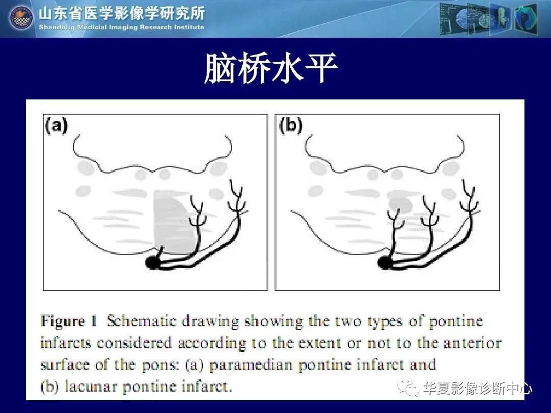 影像PPT - 【PPT】缺血性脑血管病的影像诊断-29