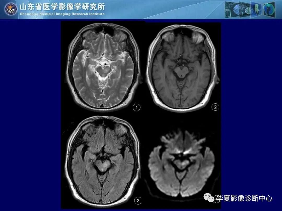 影像PPT - 【PPT】缺血性脑血管病的影像诊断-32