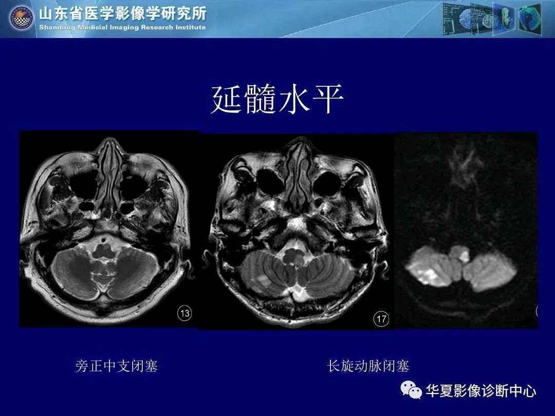 影像PPT - 【PPT】缺血性脑血管病的影像诊断-34