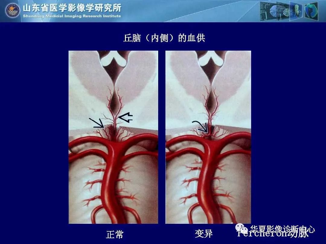 影像PPT - 【PPT】缺血性脑血管病的影像诊断-35