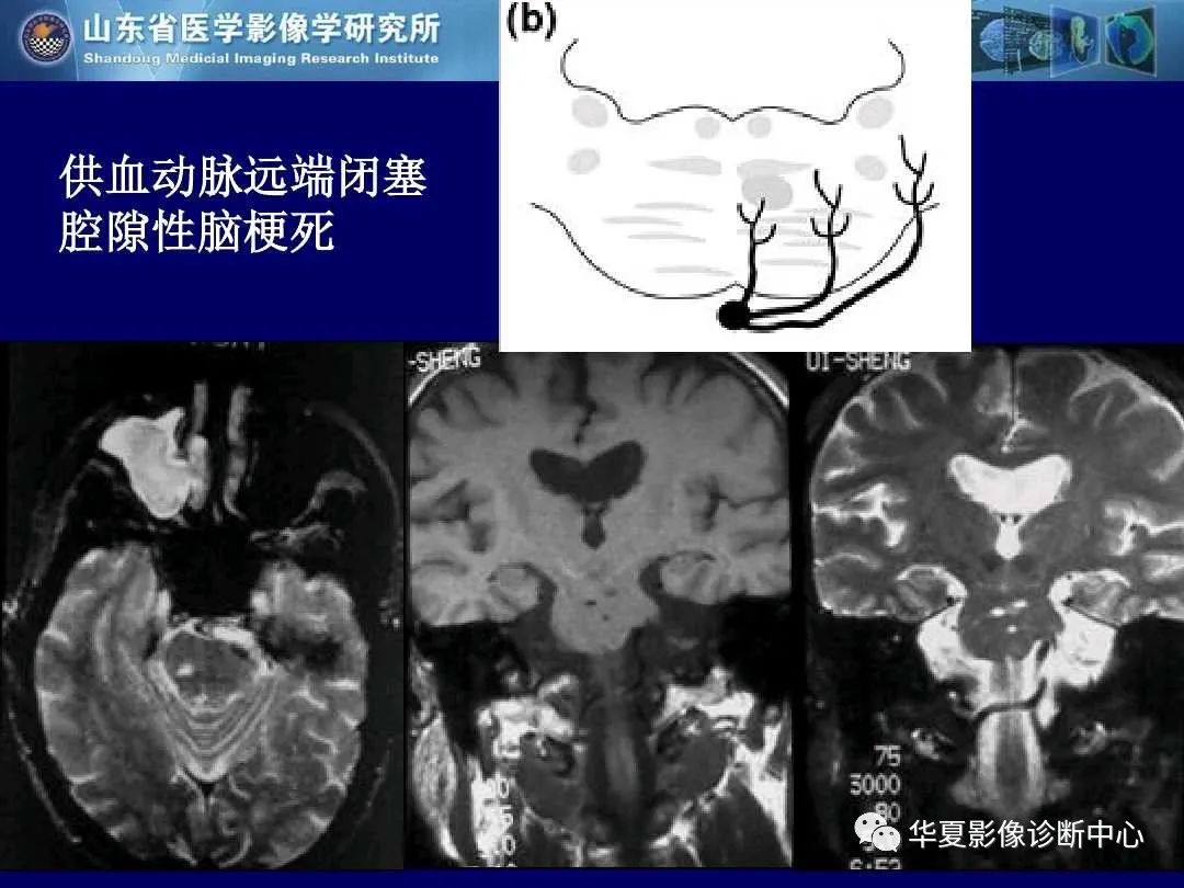 影像PPT - 【PPT】缺血性脑血管病的影像诊断-37