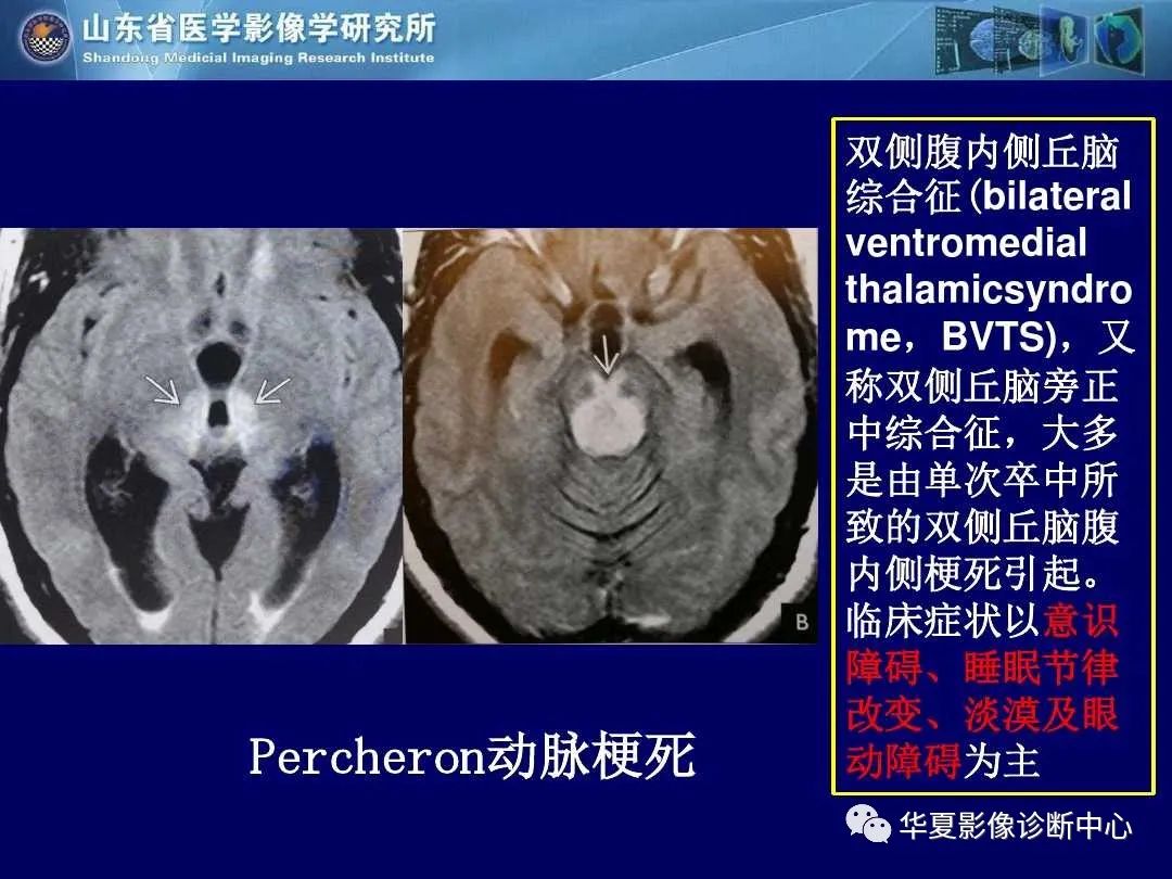 影像PPT - 【PPT】缺血性脑血管病的影像诊断-36