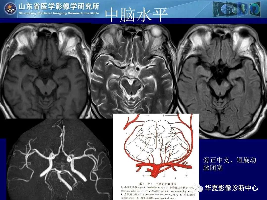 影像PPT - 【PPT】缺血性脑血管病的影像诊断-33