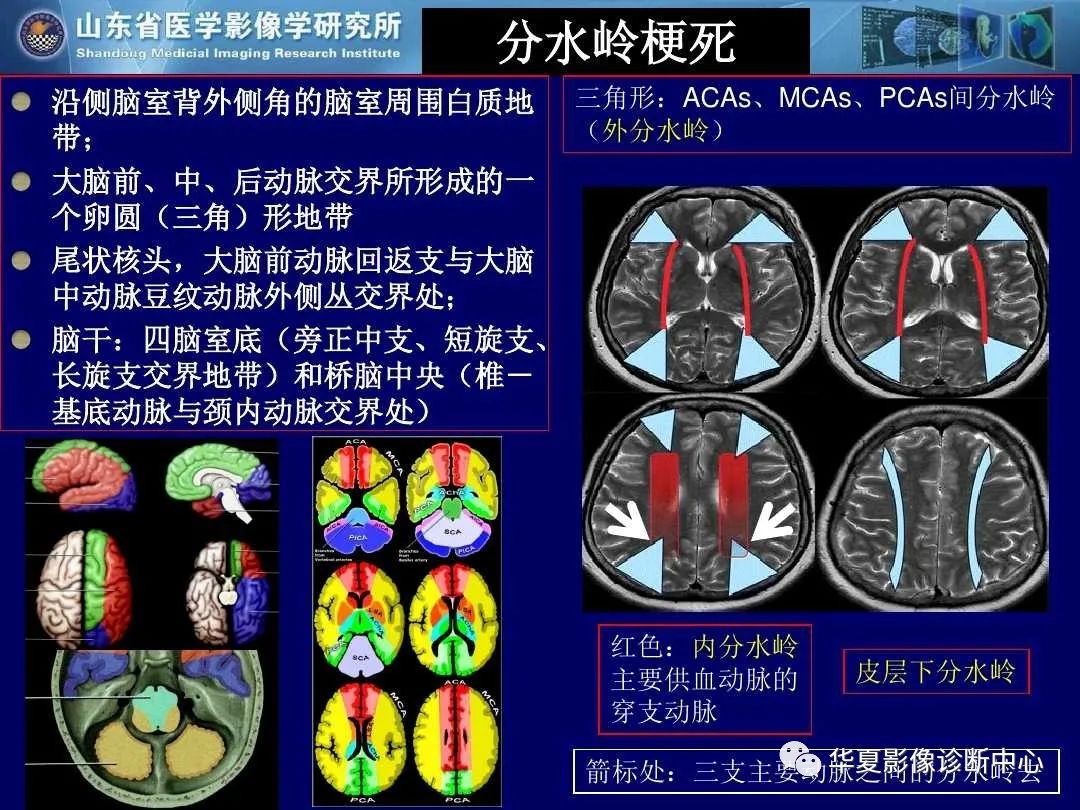 影像PPT - 【PPT】缺血性脑血管病的影像诊断-39