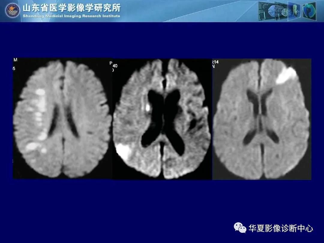 影像PPT - 【PPT】缺血性脑血管病的影像诊断-40