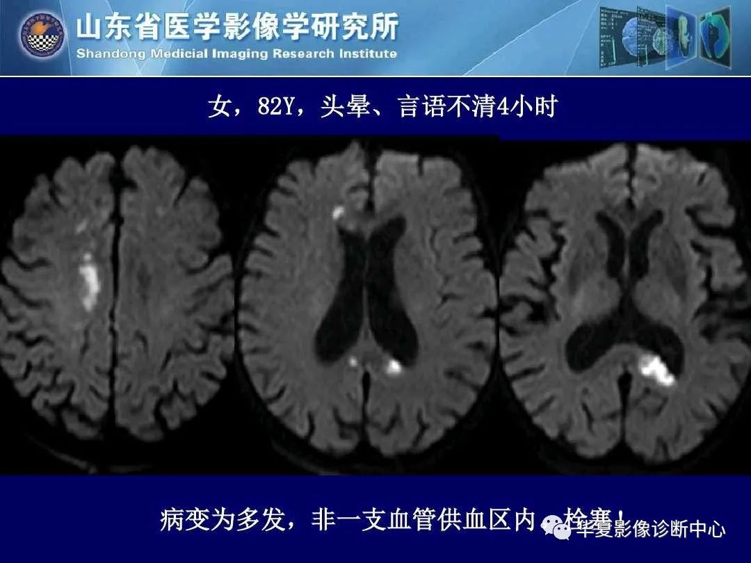 影像PPT - 【PPT】缺血性脑血管病的影像诊断-42