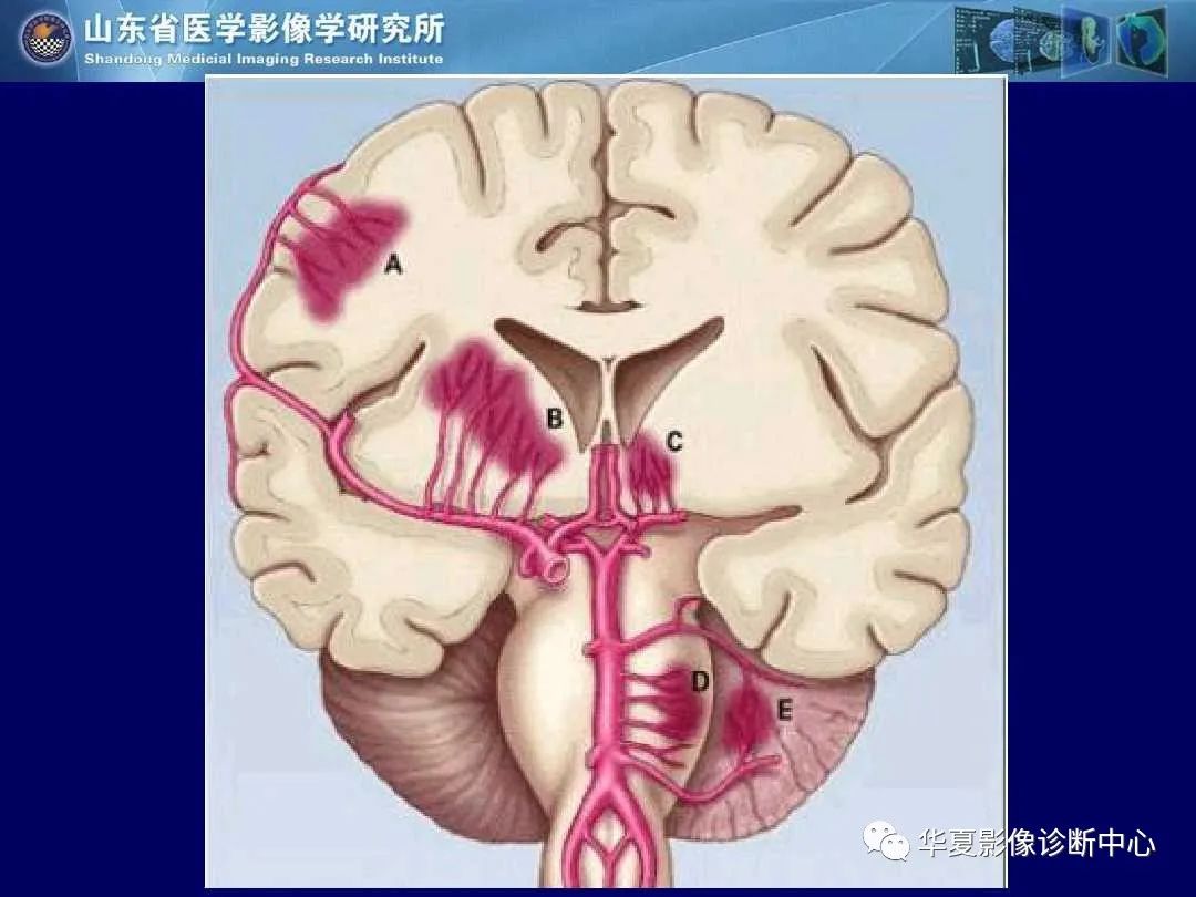影像PPT - 【PPT】缺血性脑血管病的影像诊断-45