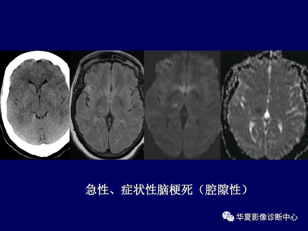 影像PPT - 【PPT】缺血性脑血管病的影像诊断-47