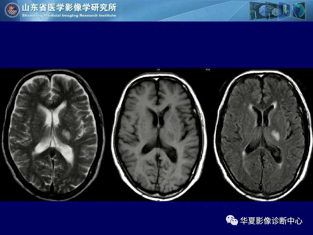 影像PPT - 【PPT】缺血性脑血管病的影像诊断-48