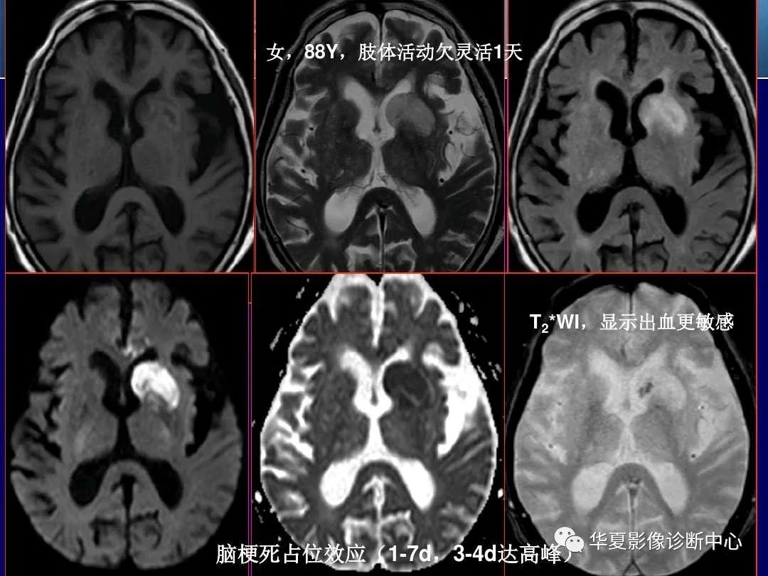 影像PPT - 【PPT】缺血性脑血管病的影像诊断-49