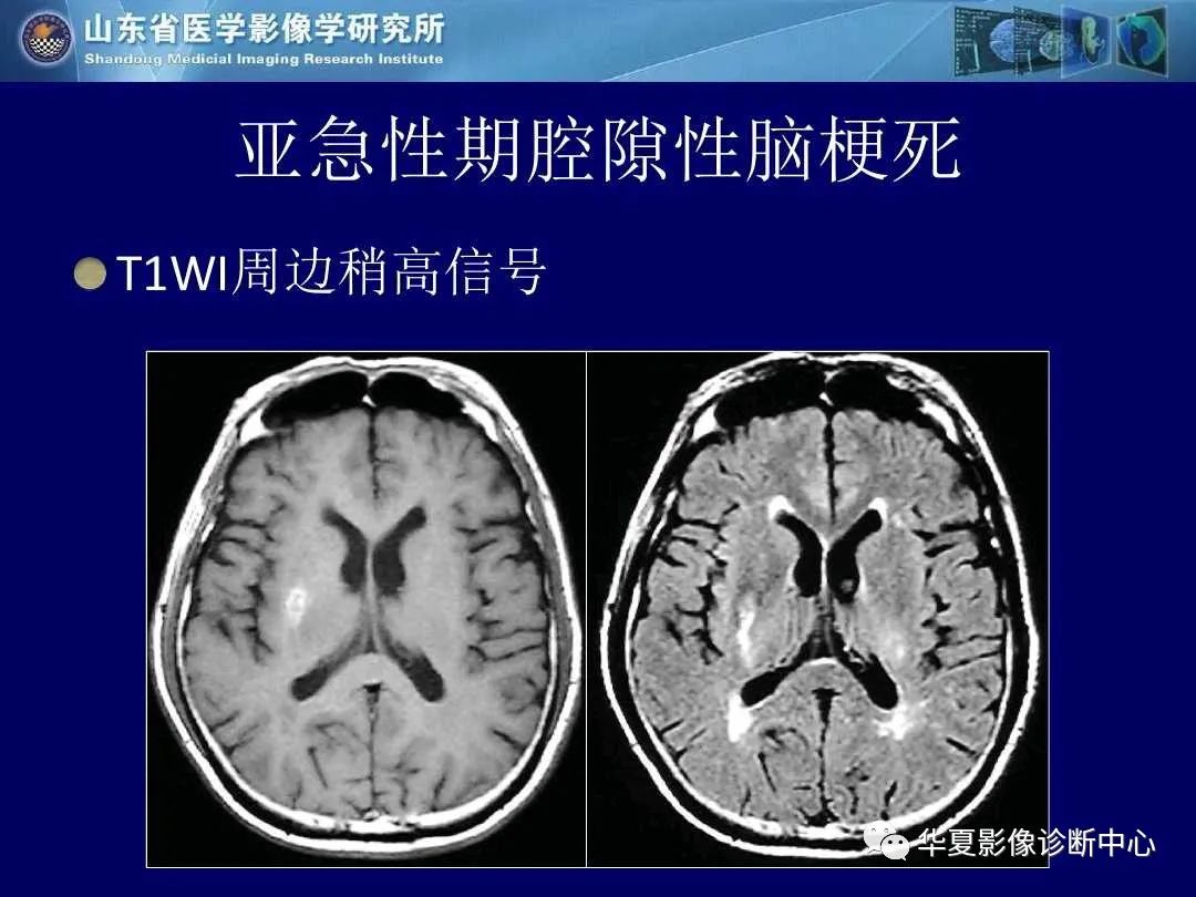 影像PPT - 【PPT】缺血性脑血管病的影像诊断-50