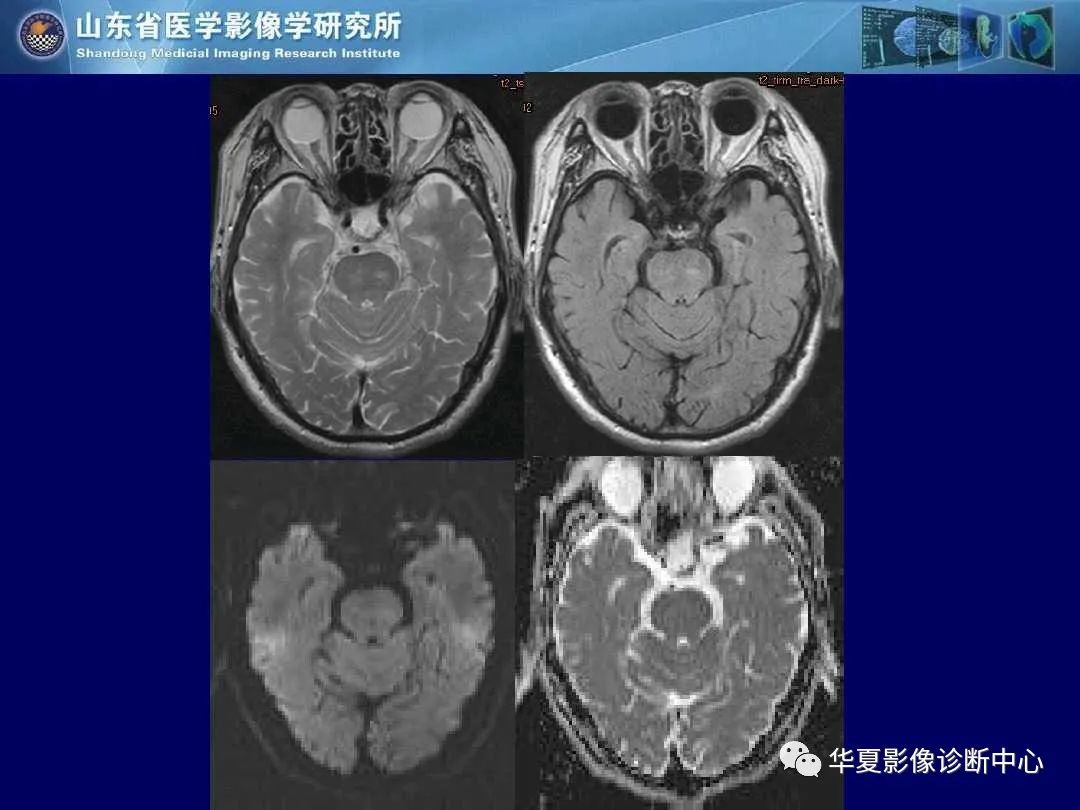 影像PPT - 【PPT】缺血性脑血管病的影像诊断-51