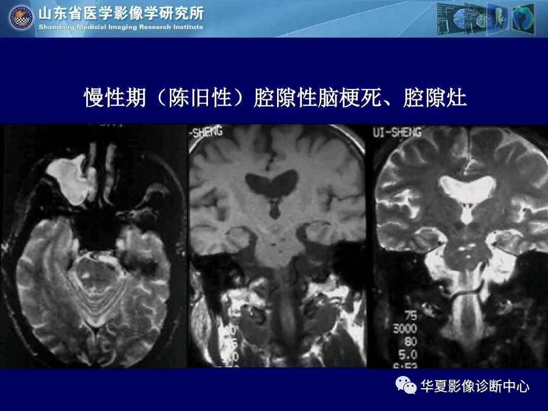 影像PPT - 【PPT】缺血性脑血管病的影像诊断-53