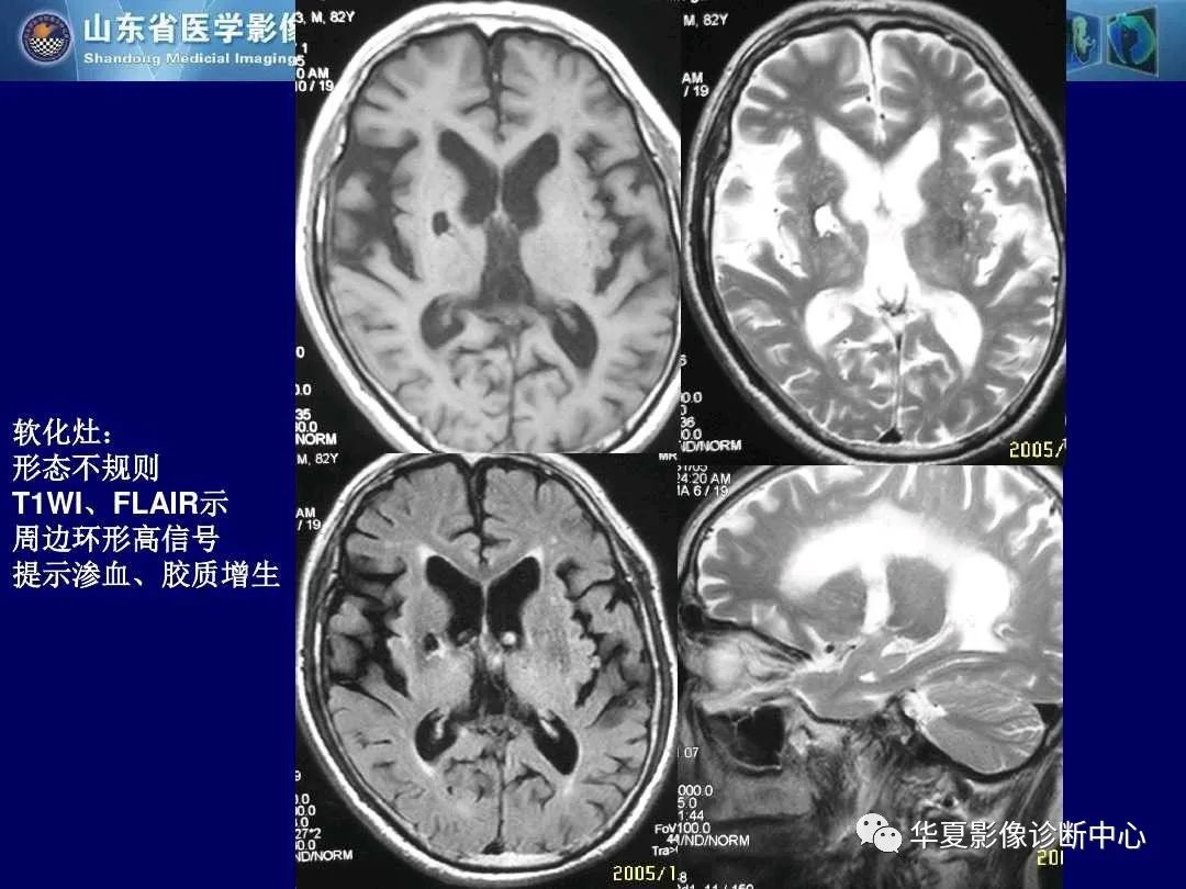影像PPT - 【PPT】缺血性脑血管病的影像诊断-52