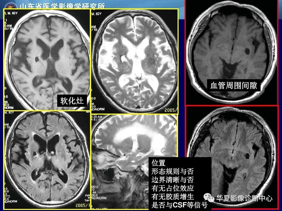 影像PPT - 【PPT】缺血性脑血管病的影像诊断-55