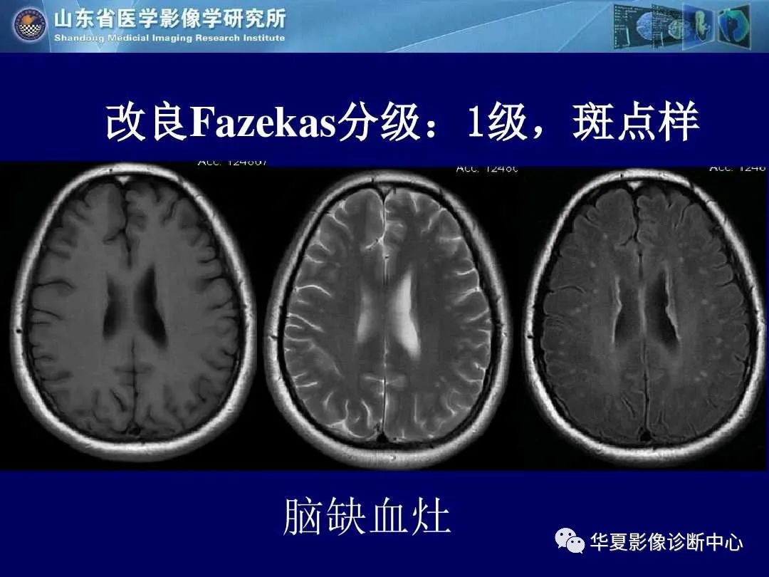 影像PPT - 【PPT】缺血性脑血管病的影像诊断-61
