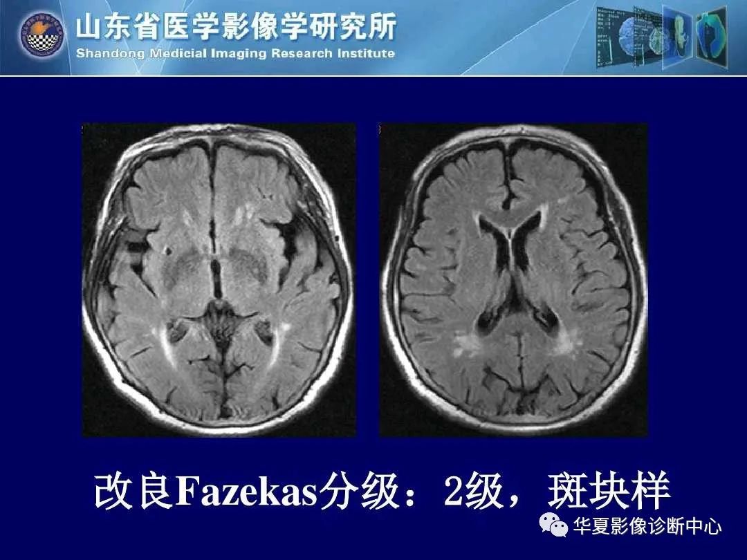影像PPT - 【PPT】缺血性脑血管病的影像诊断-62