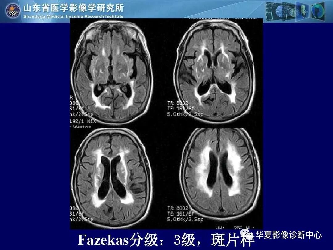 影像PPT - 【PPT】缺血性脑血管病的影像诊断-63