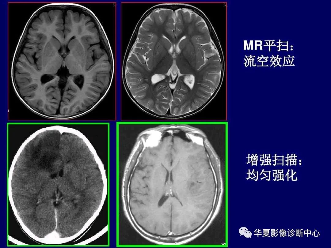 影像PPT - 【PPT】缺血性脑血管病的影像诊断-73