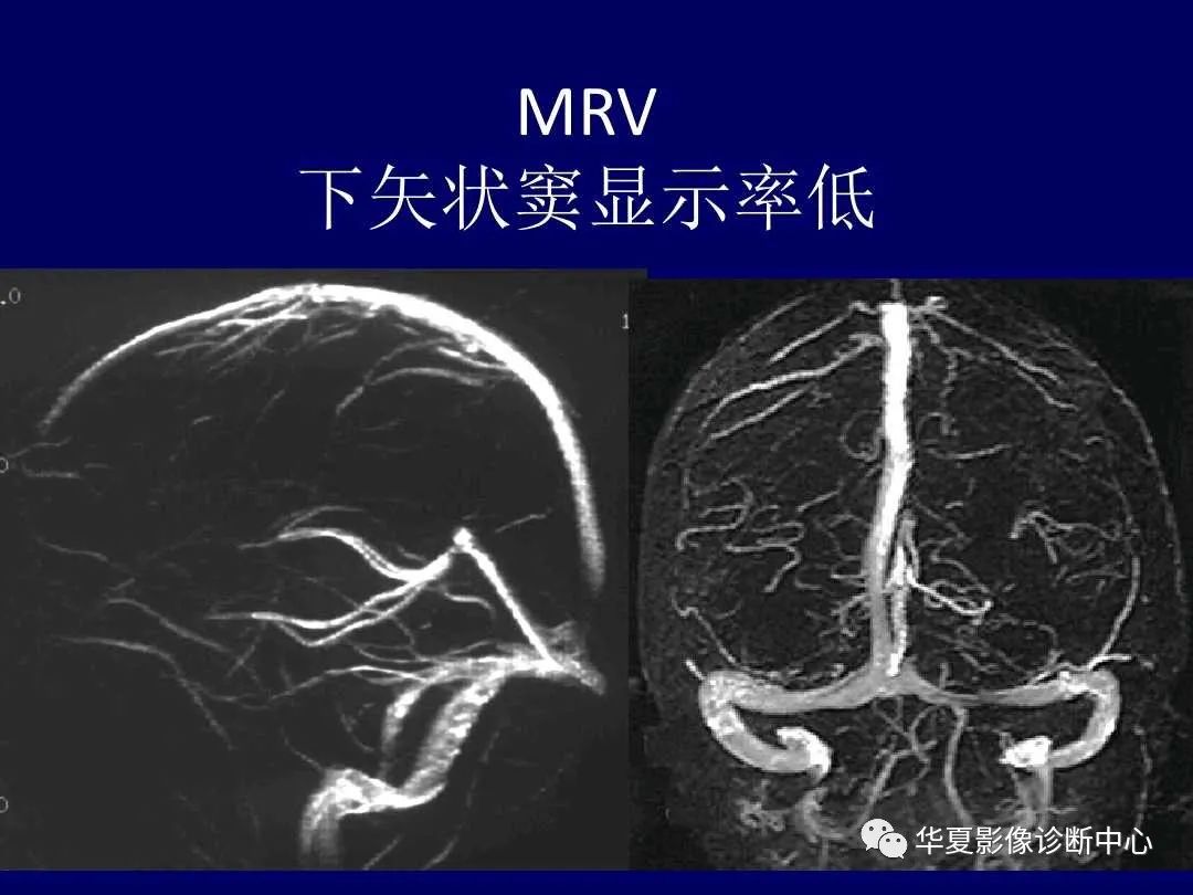 影像PPT - 【PPT】缺血性脑血管病的影像诊断-74