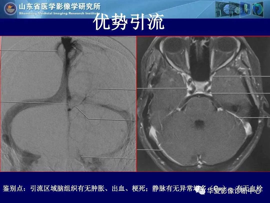 影像PPT - 【PPT】缺血性脑血管病的影像诊断-75