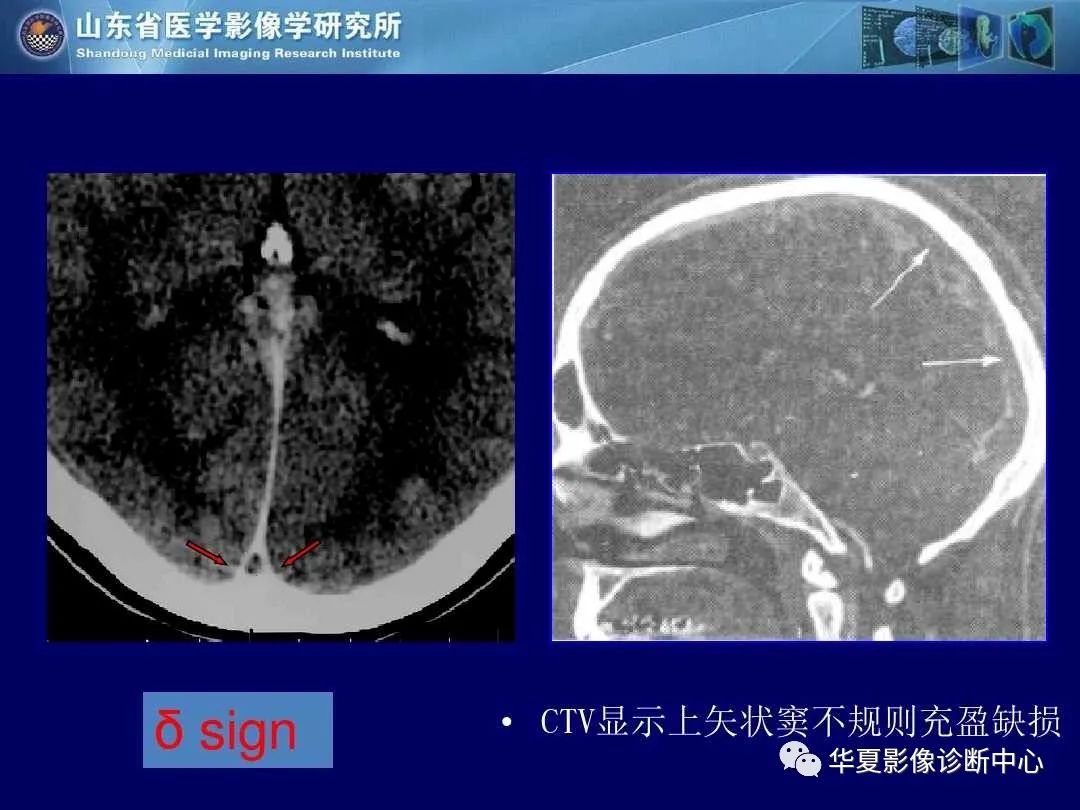 影像PPT - 【PPT】缺血性脑血管病的影像诊断-78