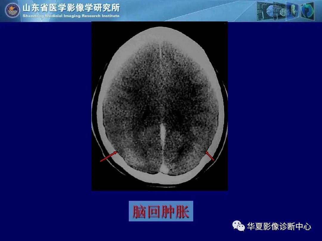 影像PPT - 【PPT】缺血性脑血管病的影像诊断-80
