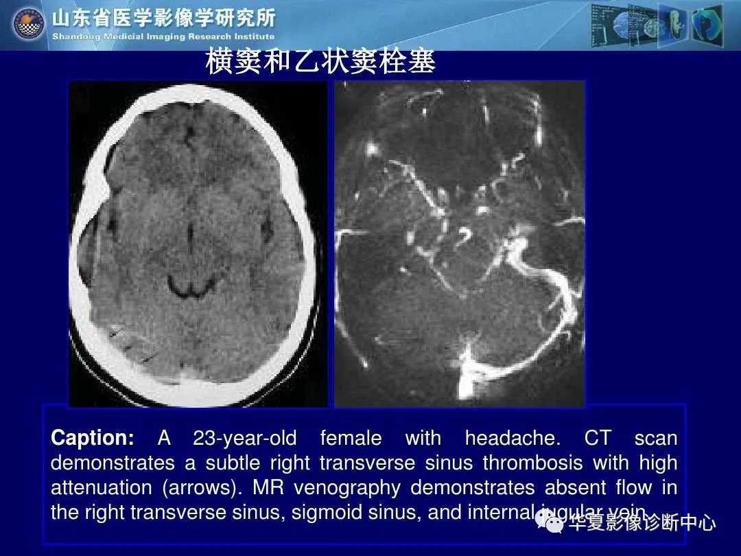 影像PPT - 【PPT】缺血性脑血管病的影像诊断-83