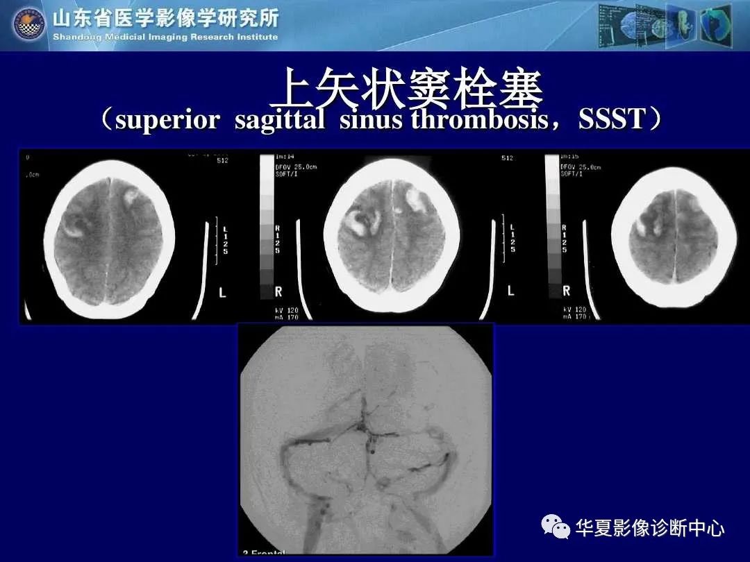 影像PPT - 【PPT】缺血性脑血管病的影像诊断-82