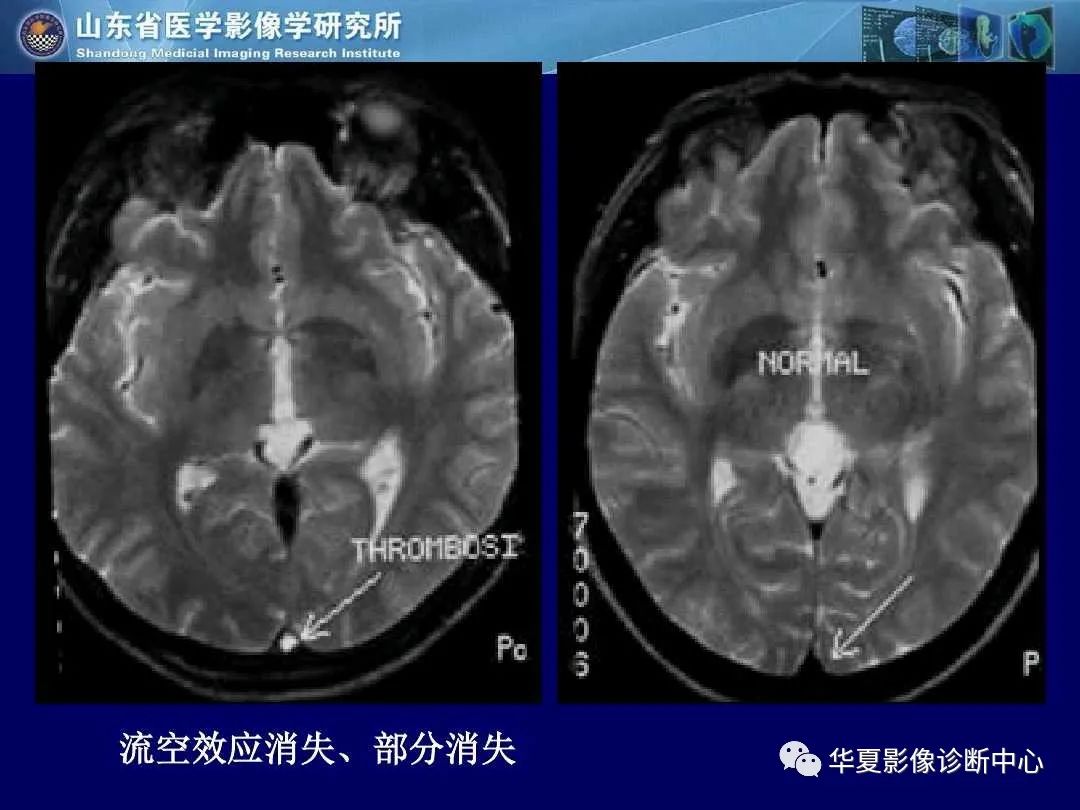 影像PPT - 【PPT】缺血性脑血管病的影像诊断-85