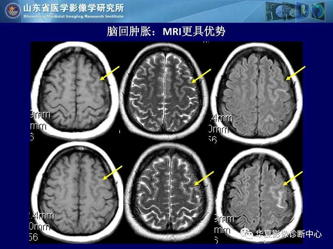 影像PPT - 【PPT】缺血性脑血管病的影像诊断-81