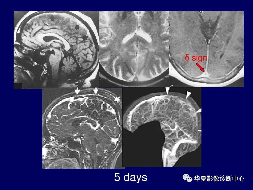 影像PPT - 【PPT】缺血性脑血管病的影像诊断-88