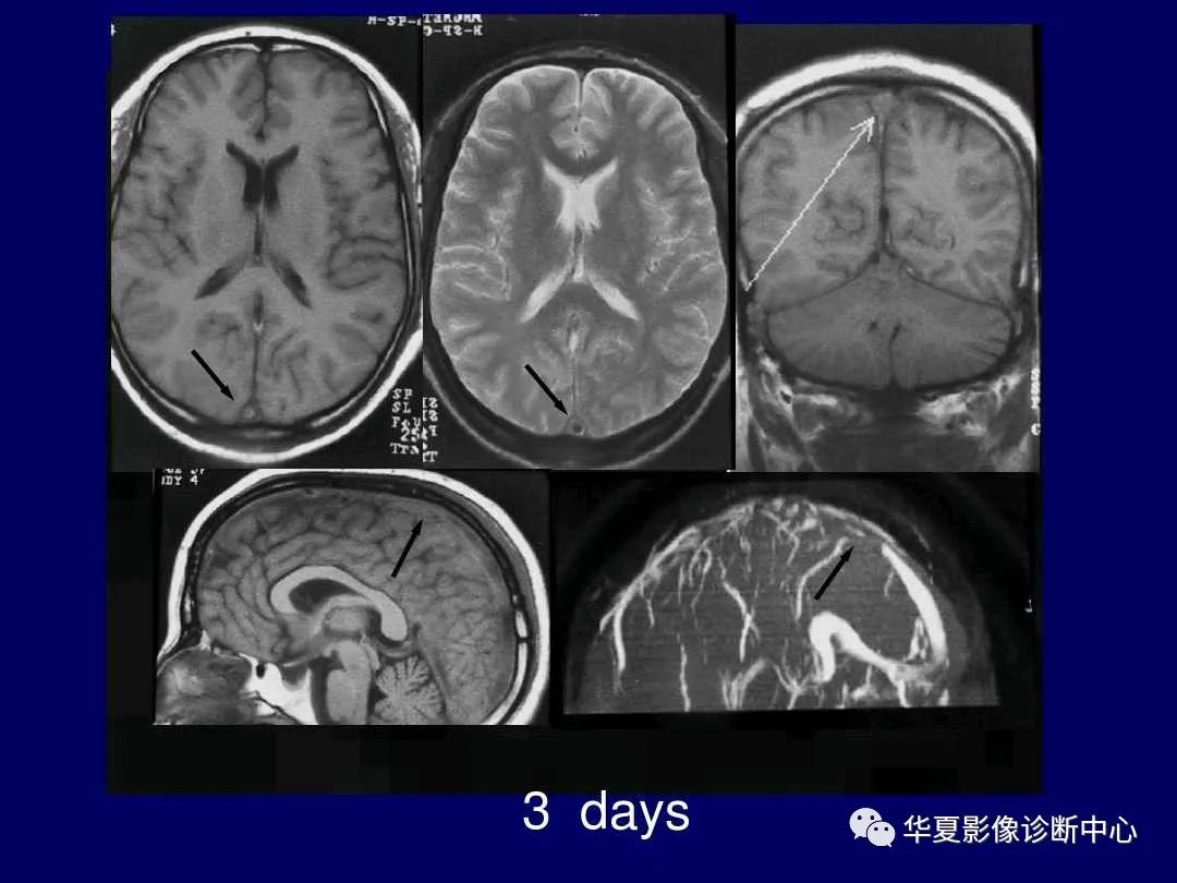 影像PPT - 【PPT】缺血性脑血管病的影像诊断-87
