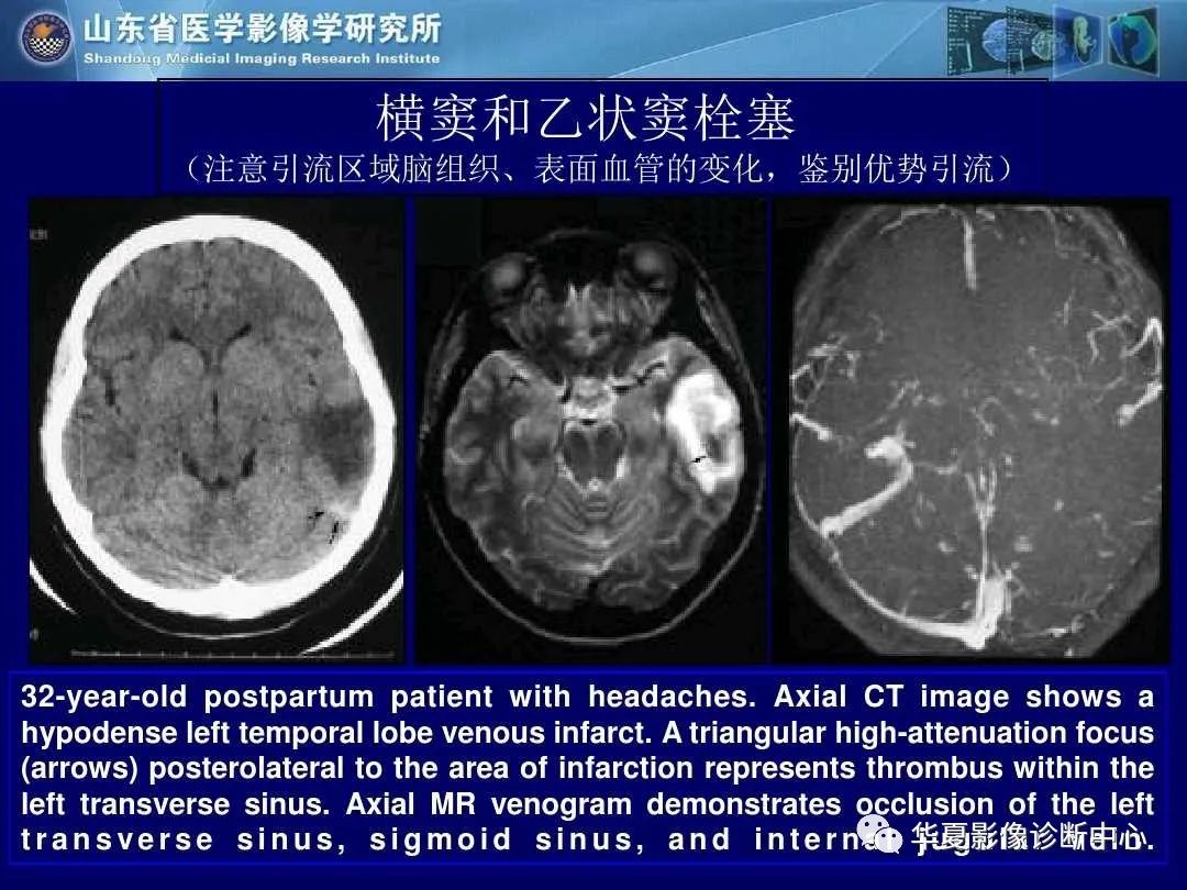 影像PPT - 【PPT】缺血性脑血管病的影像诊断-93