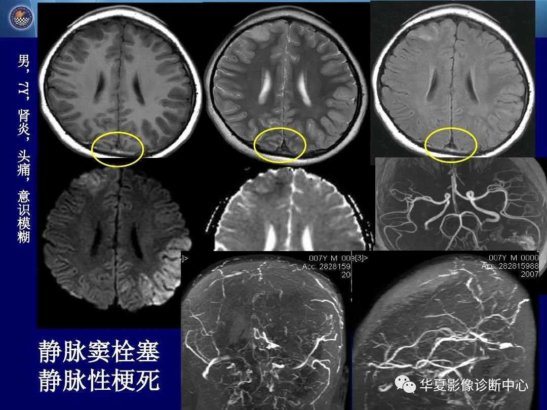 影像PPT - 【PPT】缺血性脑血管病的影像诊断-96