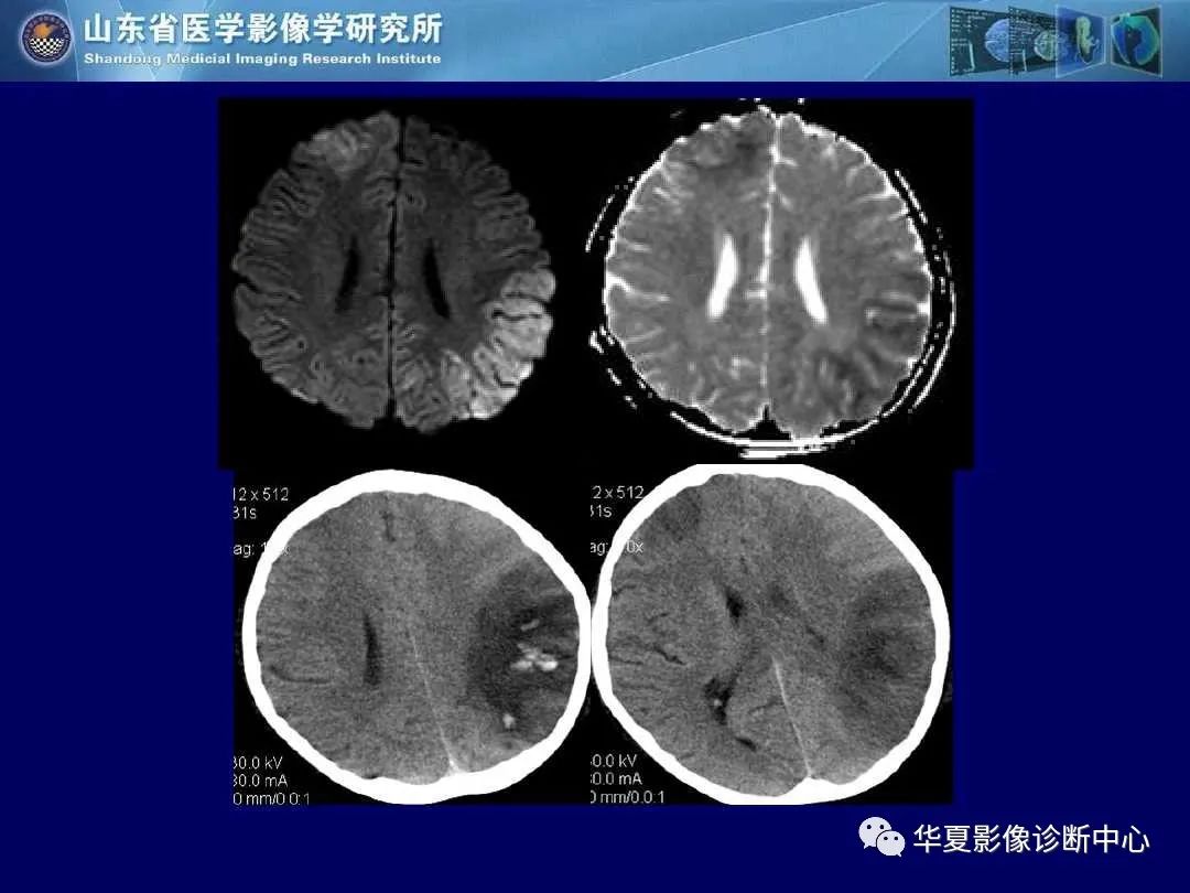 影像PPT - 【PPT】缺血性脑血管病的影像诊断-97