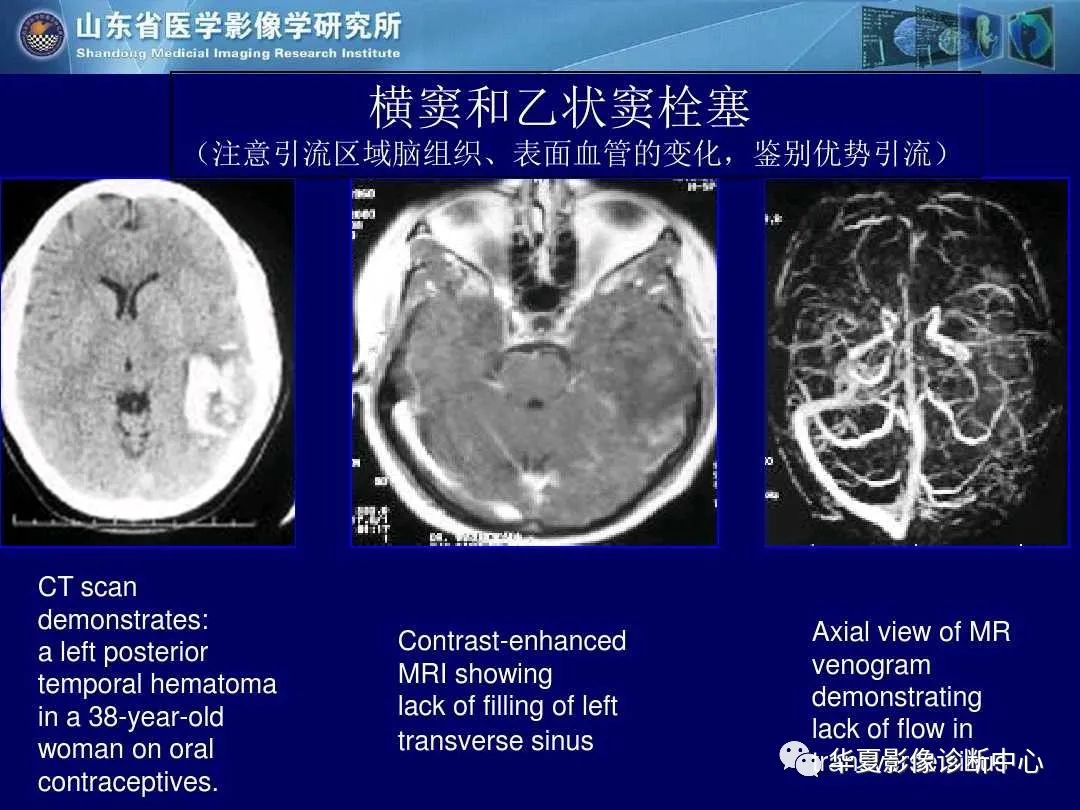 影像PPT - 【PPT】缺血性脑血管病的影像诊断-94