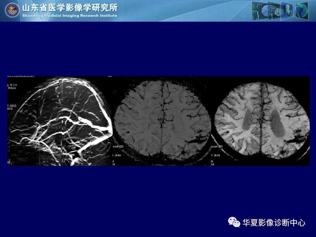 影像PPT - 【PPT】缺血性脑血管病的影像诊断-98