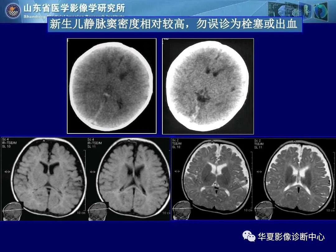 影像PPT - 【PPT】缺血性脑血管病的影像诊断-102