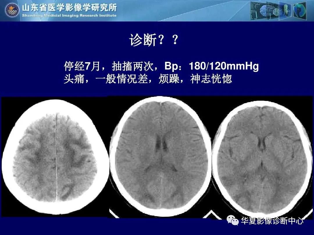 影像PPT - 【PPT】缺血性脑血管病的影像诊断-103